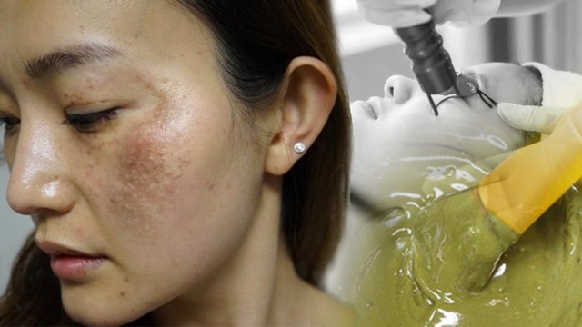 bai-viet/nam-ba-che-nguyen-nhan-dieu-tri-va-cach-phong-ngua.html