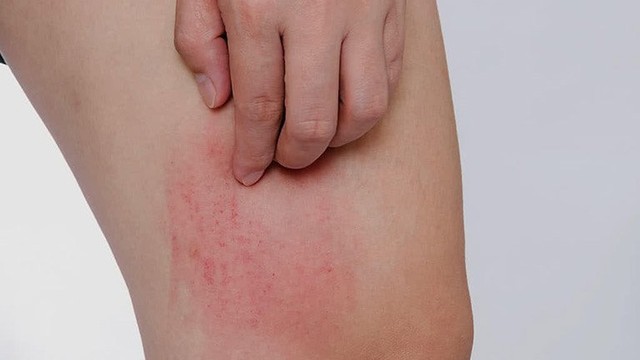 bai-viet/nam-da-dui-nguyen-nhan-trieu-chung-va-cach-dieu-tri-hieu-qua.html