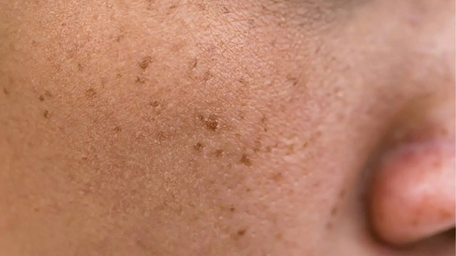 bai-viet/nam-dom-la-gi-mot-so-bien-phap-ho-tro-dieu-tri-nam-dom-tai-nha.html