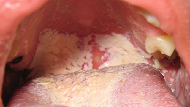 bai-viet/nam-khoang-mieng-la-benh-gi-57082.html