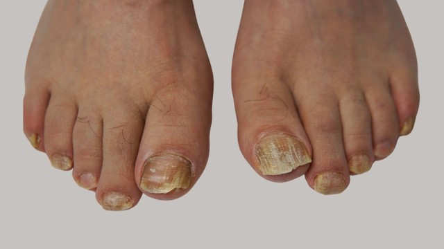 bai-viet/benh-nam-mong-chan-nguyen-nhan-trieu-chung-va-cach-dieu-tri.html