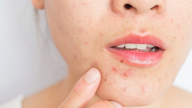 bai-viet/nan-mun-dinh-rau-co-bi-meo-mom-hay-khong.html