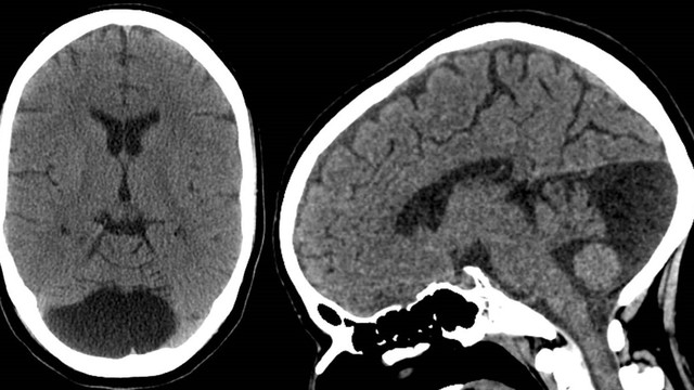 bai-viet/nang-mang-nhen-o-tre-em-co-nguy-hiem-khong.html