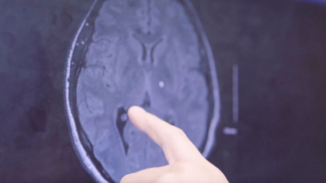 bai-viet/nang-mang-nhen-co-nguy-hiem-khong-tim-hieu-trieu-chung-nguy-co-va-cach-dieu-tri.html