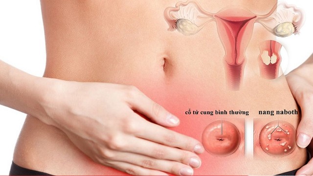 bai-viet/nang-naboth-co-tu-cung-11mm-co-nguy-hiem-khong.html