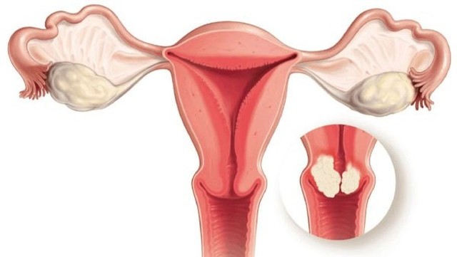 Nang naboth cổ tử cung​