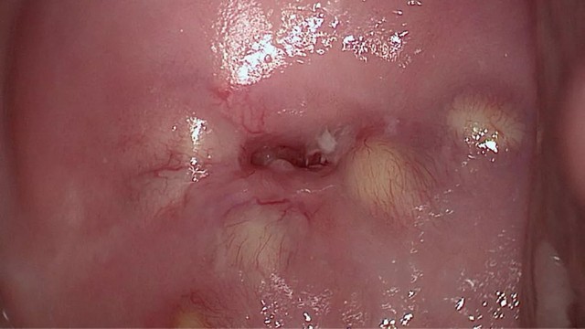 bai-viet/nang-naboth-co-tu-cung-4mm-co-mang-thai-duoc-khong.html