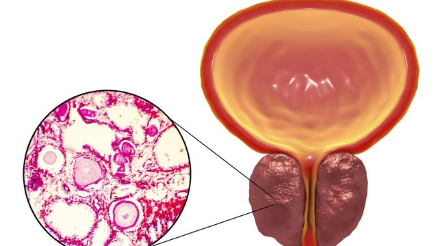 bai-viet/nang-tuyen-tien-liet-la-gi-nguyen-nhan-va-cach-thay-doi-loi-song-de-dieu-tri-hieu-qua.html