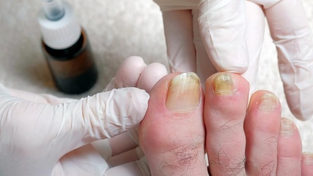 bai-viet/nen-lam-gi-khi-lay-khoe-mong-chan-sau-bi-sung-mu-59832.html