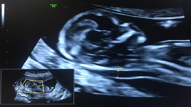 bai-viet/nep-gap-da-gay-la-gi-tai-sao-do-nep-gap-da-gay-lai-quan-trong.html