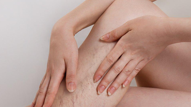 bai-viet/ngam-chan-tri-suy-gian-tinh-mach-co-that-su-hieu-qua-72989.html