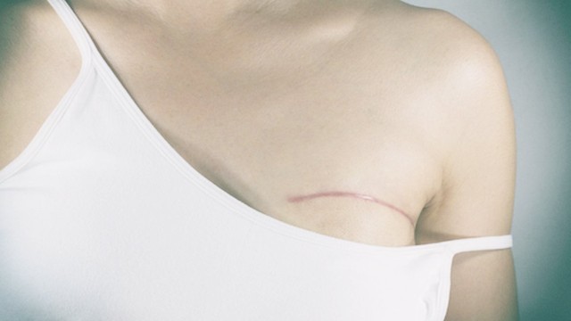 bai-viet/thong-tin-ve-ngay-phau-thuat-danh-cho-benh-nhan-ung-thu-vu-55895.html