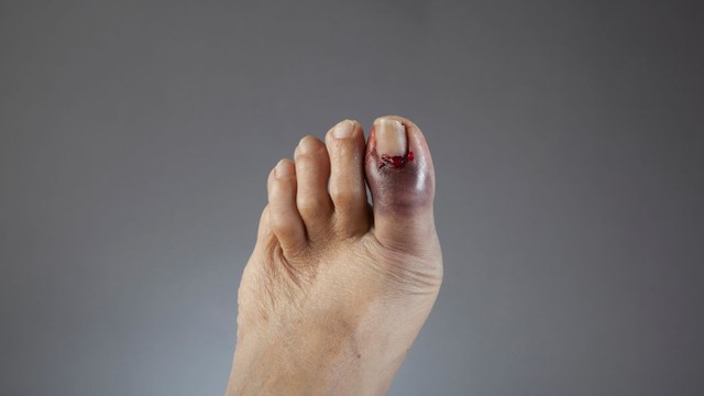 bai-viet/ngon-chan-bi-sung-la-trieu-chung-benh-gi-lam-gi-khi-ngon-chan-bi-sung.html