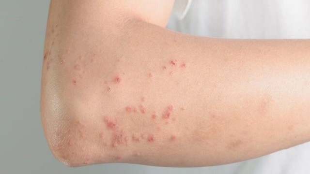 bai-viet/ngua-noi-me-day-toan-than-co-gay-nguy-hiem-hay-khong.html