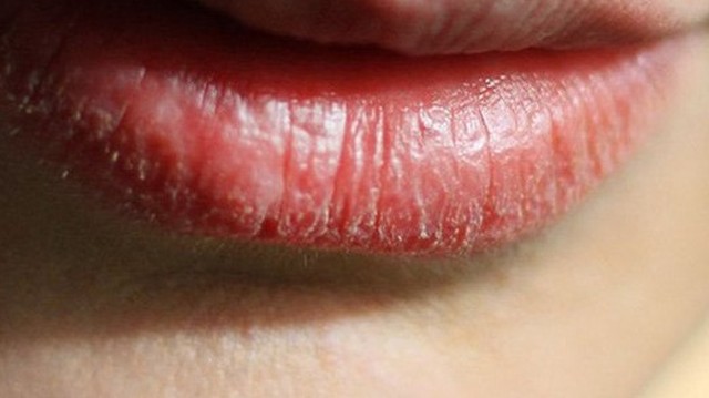 bai-viet/ngua-ram-ran-o-moi-la-dau-hieu-gi-67348.html