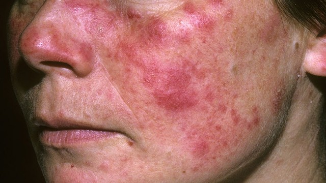 bai-viet/nguoi-bi-benh-lupus-ban-do-nen-kieng-an-gi-56877.html