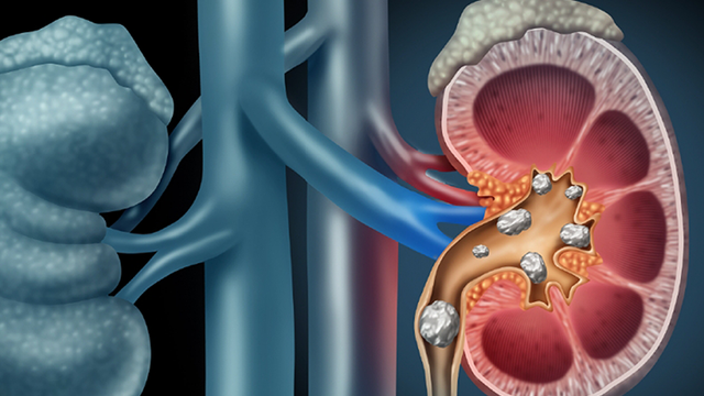 bai-viet/nguoi-bi-soi-than-uong-gi-de-ho-tro-dieu-tri-benh-tot-hon.html