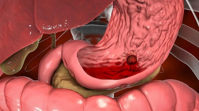 bai-viet/nguoi-bi-xuat-huyet-da-day-nen-an-gi-va-khong-nen-an-nhung-gi.html