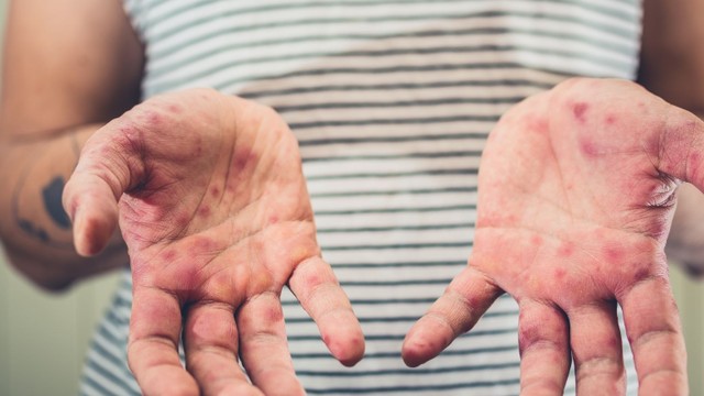 bai-viet/nguoi-lon-bi-tay-chan-mieng-uong-thuoc-gi-nguyen-tac-dieu-tri-benh-tay-chan-mieng.html