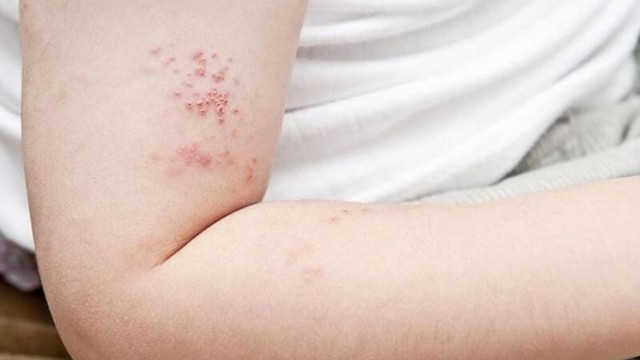 bai-viet/nguyen-nhan-benh-zona-va-cac-bien-chung-thuong-gap.html