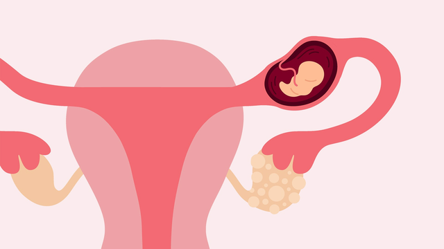 bai-viet/nguyen-nhan-bi-thai-ngoai-tu-cung-2-lan-va-cach-phong-ngua.html