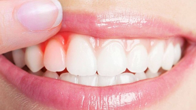 bai-viet/nguyen-nhan-chay-mau-nuou-rang-va-cach-khac-phuc.html