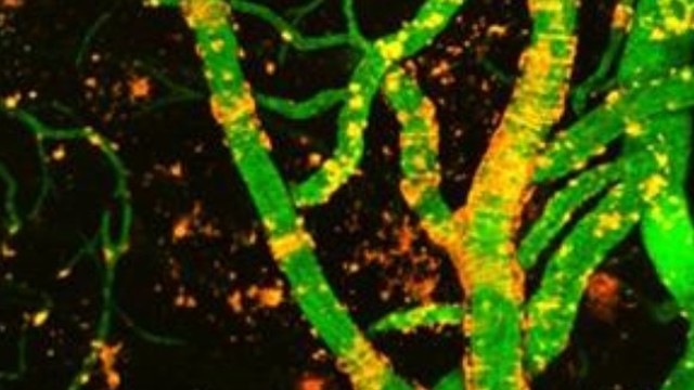 bai-viet/nguyen-nhan-gay-benh-mach-mau-dang-bot-la-gi-phuong-phap-dieu-tri-the-nao.html