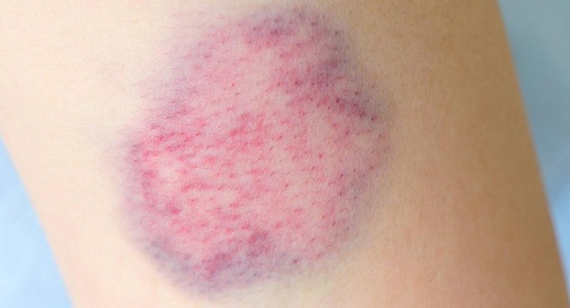 bai-viet/nguyen-nhan-gay-nen-tinh-trang-bam-tim-tren-da-47309.html