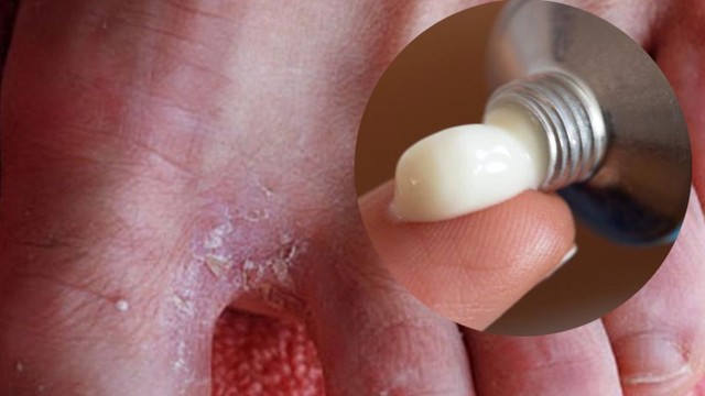 bai-viet/6-loai-thuoc-tri-nuoc-an-chan-hieu-qua-ngay-tai-nha-ma-ban-nen-biet-70388.html