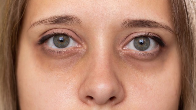 bai-viet/nguyen-nhan-gay-tham-quang-mat-va-cach-khac-phuc-hieu-qua.html