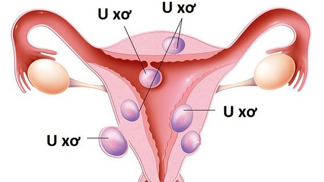 bai-viet/nguyen-nhan-gay-u-xo-tu-cung-va-cach-phong-tranh.html