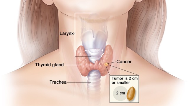 bai-viet/nguyen-nhan-gay-ung-thu-tuyen-giap-54189.html