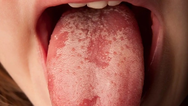 bai-viet/nguyen-nhan-luoi-noi-hat-trang-va-cach-dieu-tri.html