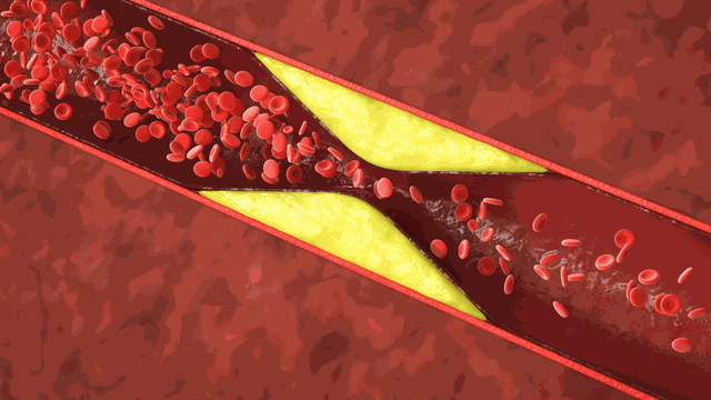 bai-viet/nguyen-nhan-mau-nhiem-mo-tu-dau-vi-sao-mau-nhiem-mo-lam-tang-nguy-co-dot-quy.html