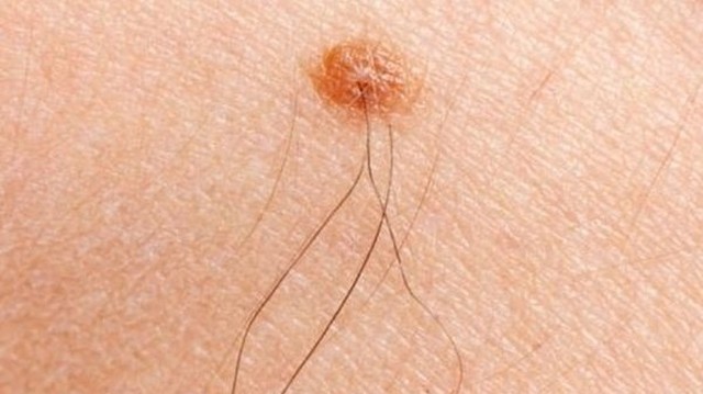 bai-viet/nguyen-nhan-moc-long-o-dau-ti-va-cach-cai-thien-an-toan-63633.html