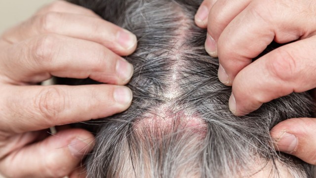 bai-viet/nguyen-nhan-bi-nam-da-dau-va-cach-dieu-tri-hieu-qua.html