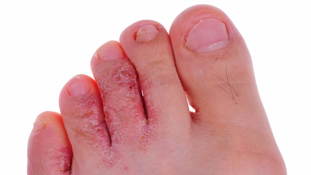 bai-viet/nguyen-nhan-nao-dan-den-ban-chan-bi-lo-ro.html