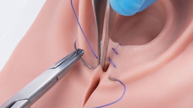 bai-viet/nguyen-nhan-nao-khien-vet-khau-tang-sinh-mon-bi-sung.html