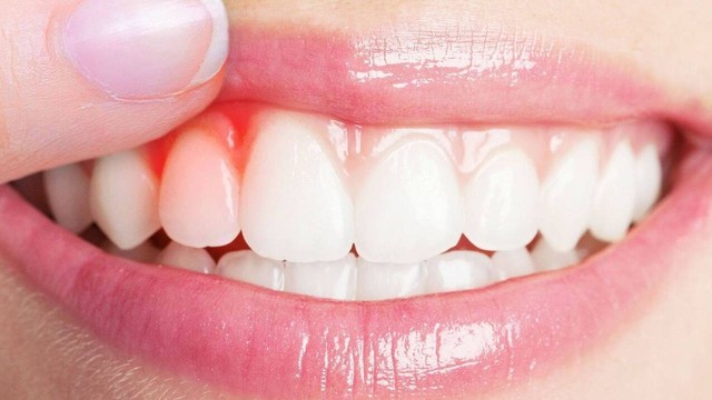 bai-viet/nguyen-nhan-nuou-rang-sung-la-gi-nhung-dieu-can-biet.html