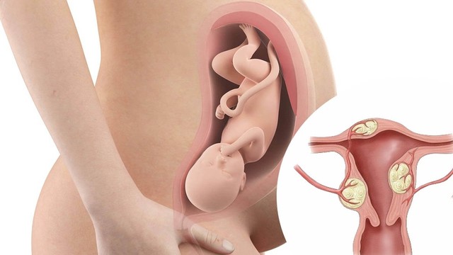 bai-viet/nguyen-nhan-u-xo-tu-cung-la-gi-u-xo-tu-cung-co-anh-huong-toi-mang-thai-khong.html