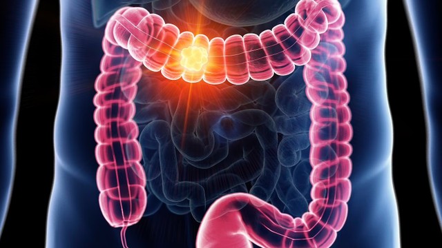 bai-viet/nguyen-nhan-ung-thu-dai-trang-va-cac-yeu-to-lam-tang-nguy-co-mac-benh.html