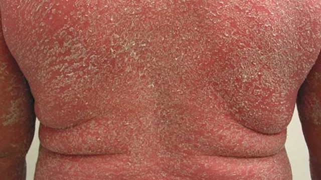 bai-viet/nguyen-nhan-va-cach-dieu-tri-benh-do-da-toan-than.html