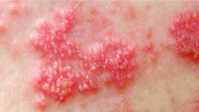 bai-viet/nguyen-nhan-mac-zona-than-kinh-o-mong-va-cach-nhan-biet.html