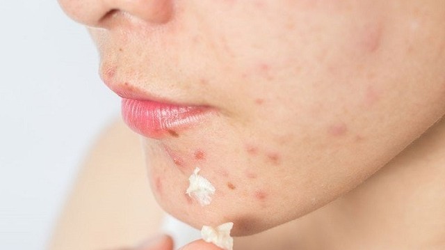 bai-viet/nguyen-nhan-va-cach-tieu-diet-cac-o-mun-viem.html