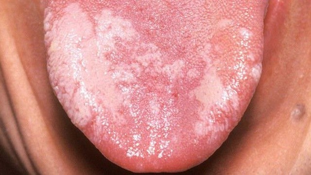 bai-viet/nguyen-nhan-va-trieu-chung-gay-benh-bach-san-niem-mac-mieng.html