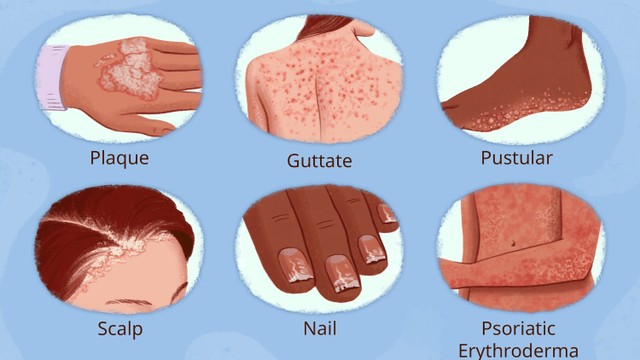 bai-viet/nguyen-nhan-va-trieu-chung-viem-khop-vay-nen-ma-ban-nen-biet.html