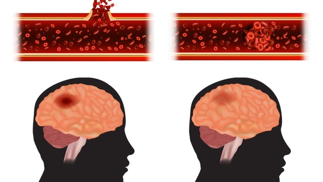 bai-viet/nguyen-nhan-xuat-huyet-nao-trieu-chung-va-cach-phong-ngua.html