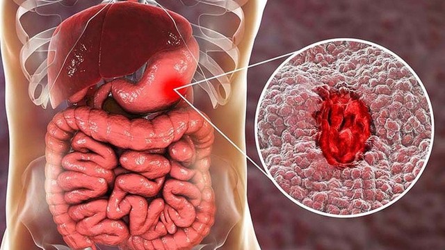 bai-viet/nhan-biet-dau-hieu-xuat-huyet-da-day-dien-hinh.html