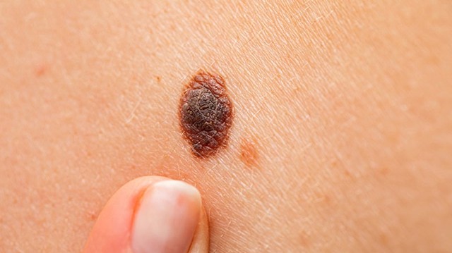 bai-viet/nhan-biet-hinh-anh-not-ruoi-ung-thu-dau-hieu-va-phuong-phap-sang-loc.html