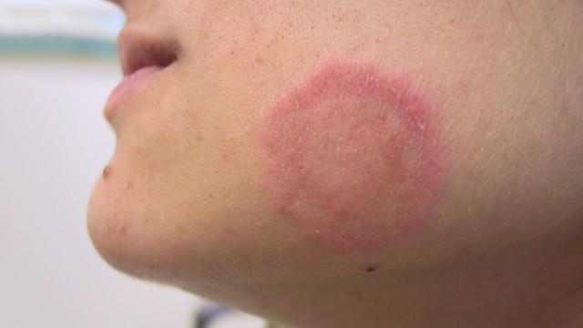 bai-viet/nhan-biet-nhanh-nhung-dau-hieu-cua-benh-hac-lao-o-tre-em-57068.html